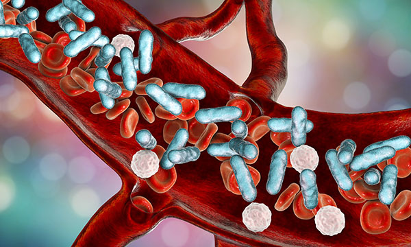 Image of sepsis
