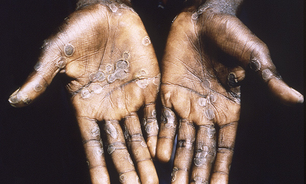 Mpox: nursing care and treatment, recognising signs and reducing risk