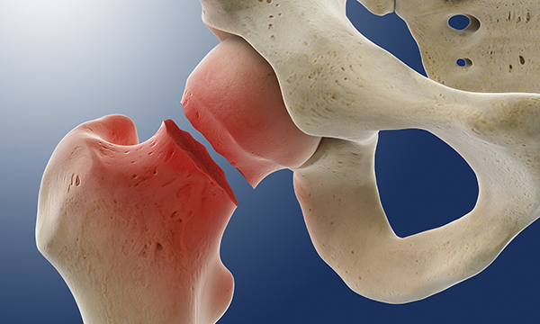 Hip fracture
