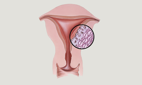 Endometriosis