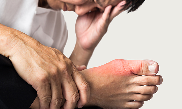 Gouty arthritis