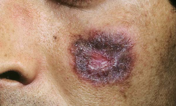 Lupus