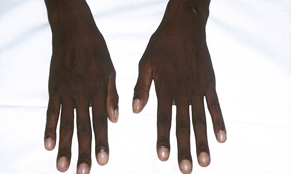 Marfan_syndrome