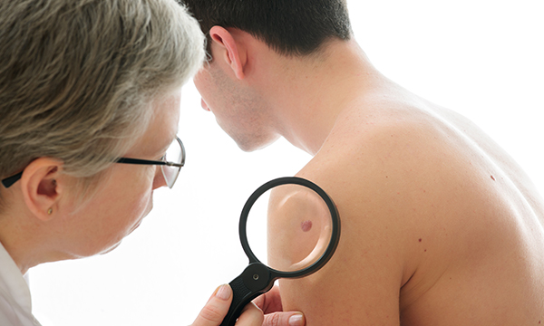 Melanoma
