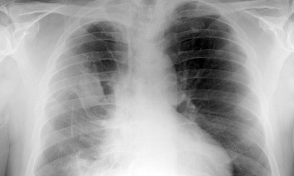 Mesothelioma