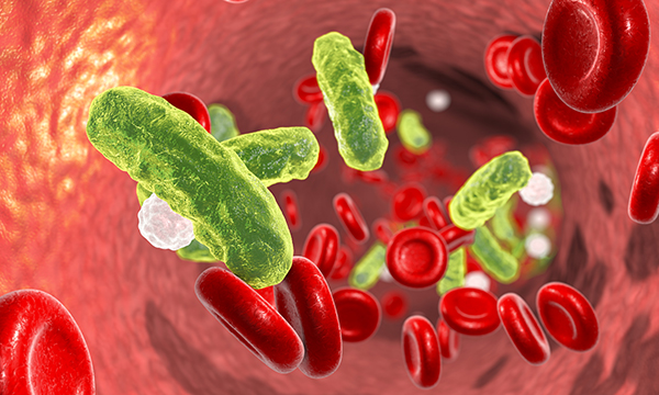 Sepsis