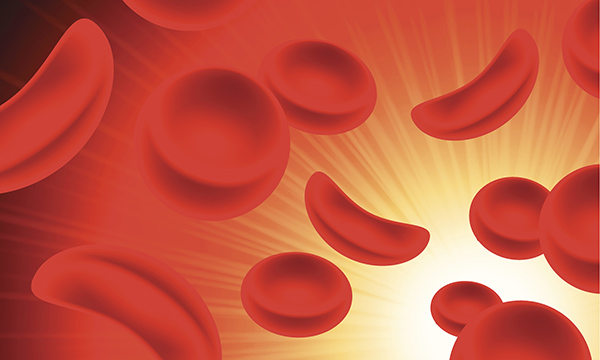 Sickle cell