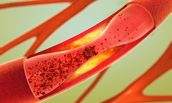 Stents