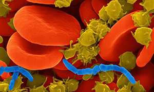 Sepsis