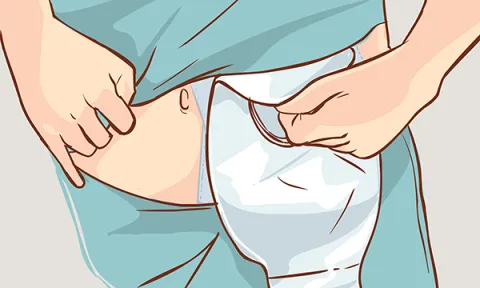 Dietary management of patients with a high-output stoma