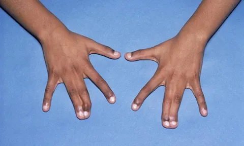 Webbed_fingers