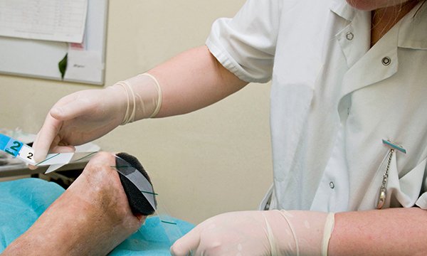 Limb amputation