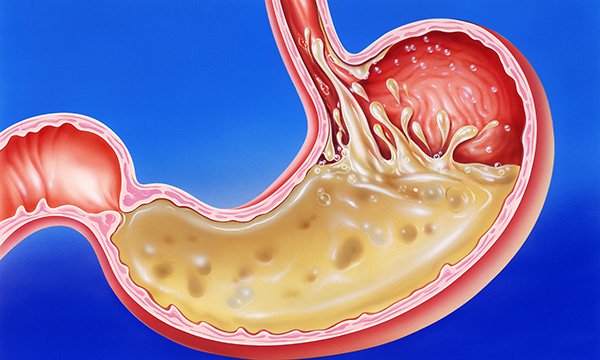 Stomach acid reflux