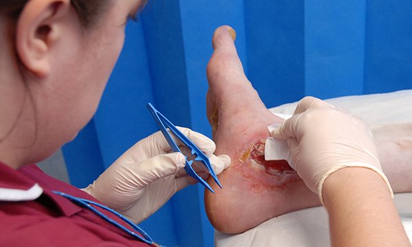 Wound care in older people: overcoming the challenges of assessment and management