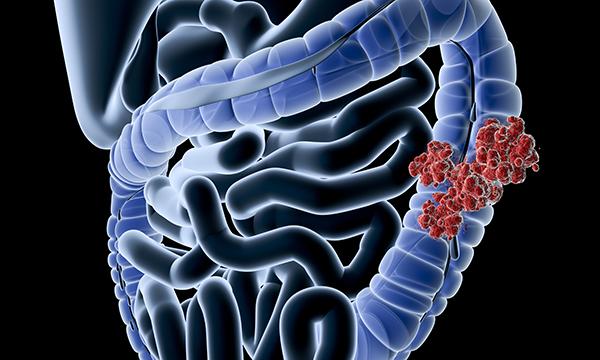 Colon cancer