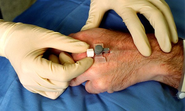 Intravenous cannula