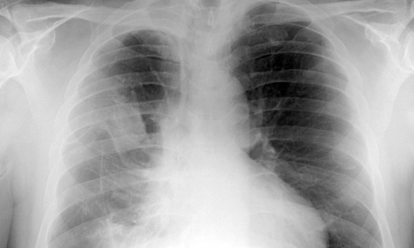 Mesothelioma