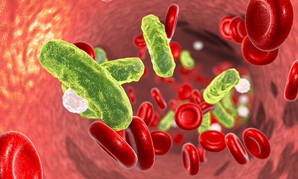 Sepsis