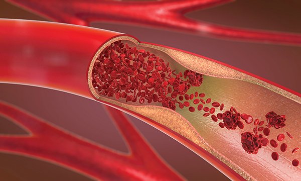 Blood disorders
