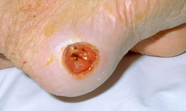 Legal implications of pressure injuries: experience of a tissue viability nurse expert